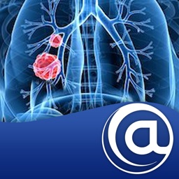 Non-Small Cell Lung Cancer