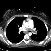 Crit-IQ CT Interpretation