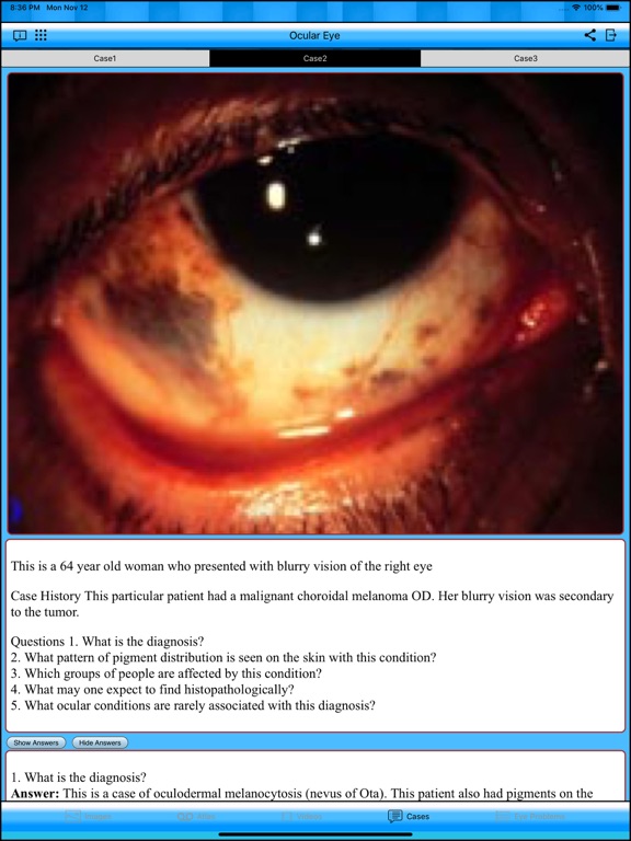 Ocular Eye iPad screenshot