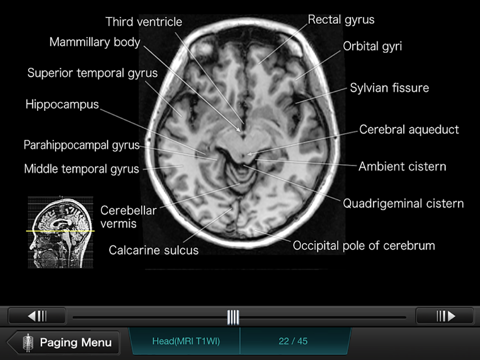 Screenshot #5 for Interactive CT and MRI Anatomy