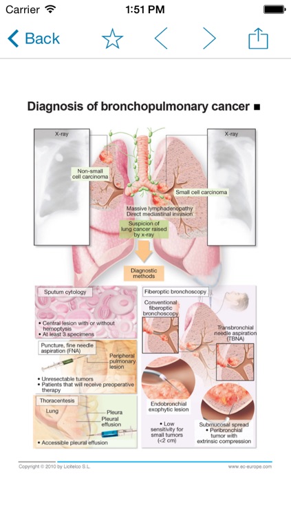 Miniatlas Lung Cancer