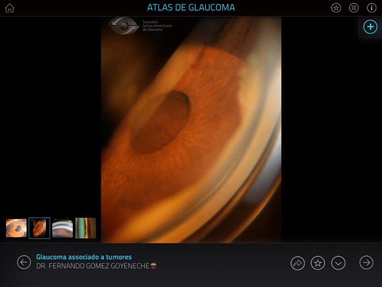 Atlas de Glaucoma screenshot-3