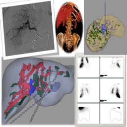Hong Kong Liver Cancer (HKLC) Staging System
