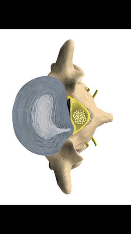 mLumbarDiscHerniation
