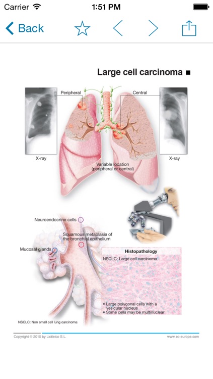 Miniatlas Lung Cancer