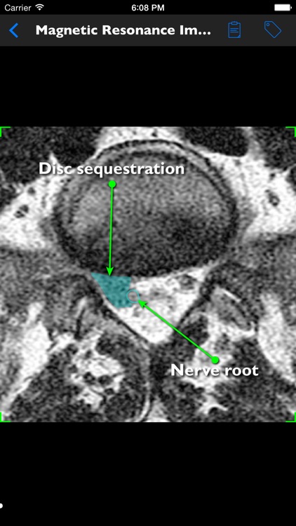 mLumbarDiscHerniation screenshot-3