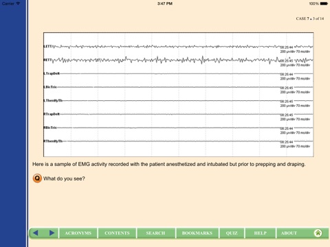 Intraoperative Neurophysiology: Interactive Case Studies by Alan D. Legatt, MD, PhD screenshot 2