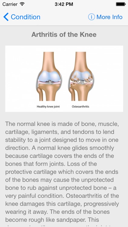 UCSF Center for Joint Replacement screenshot-3
