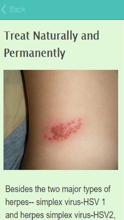 How To Treat Shingles