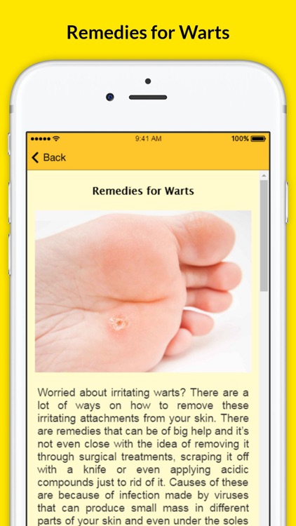 Mole Removal Remedies - Genital Wart Treatments