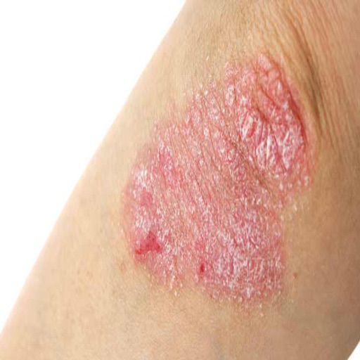 How To Treat Eczema icon