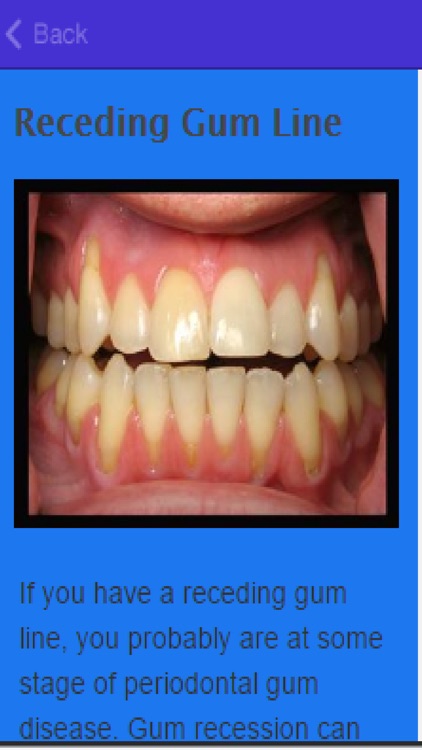 How To Stop Receding Gums