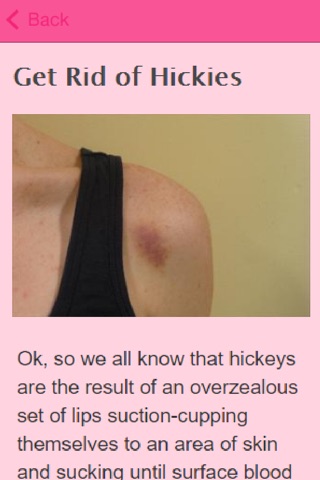How To Get Rid Of Hickeys screenshot 3