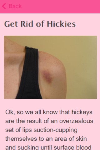How To Get Rid Of Hickeys screenshot 3