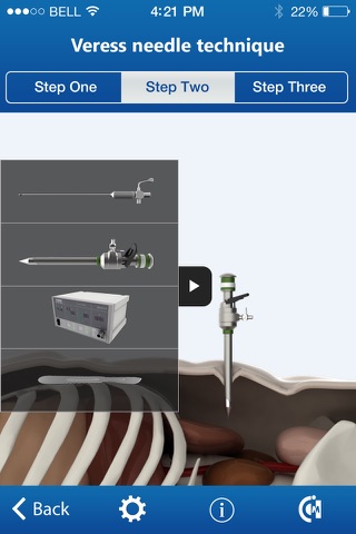 Pneumoperitoneum in humans screenshot 3