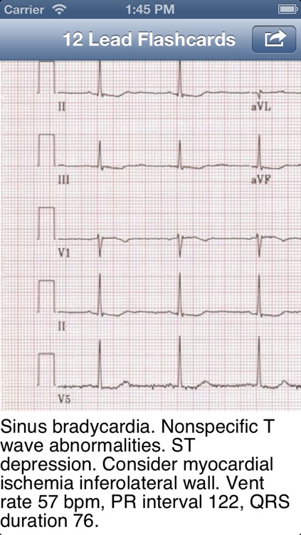 EKG Academy: Electrocardiogram Study Guide