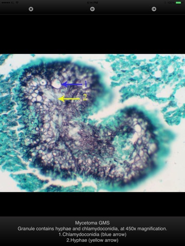 Fungal Infections in Tissues screenshot 3