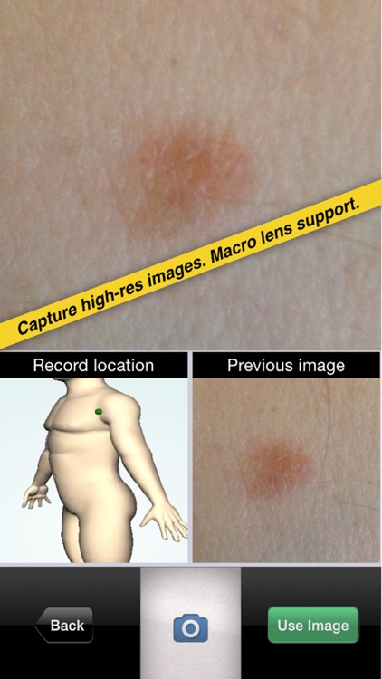 moleMonitor - Skin Cancer Mole Checker