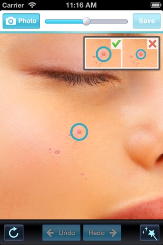 Pimple Remover + screenshot 2