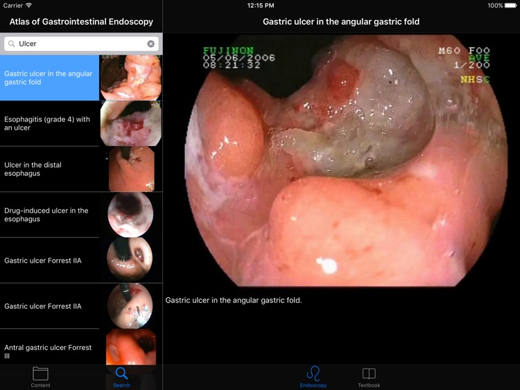 ENDO3®Atlas of GI Endoscopy HD