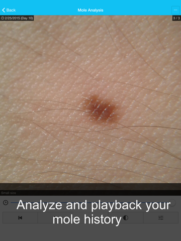 Screenshot #6 pour Skin Cancer App - MySkinPal - Map your skin moles