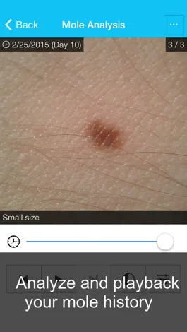 Game screenshot Skin Cancer App - MySkinPal - Map your skin moles hack