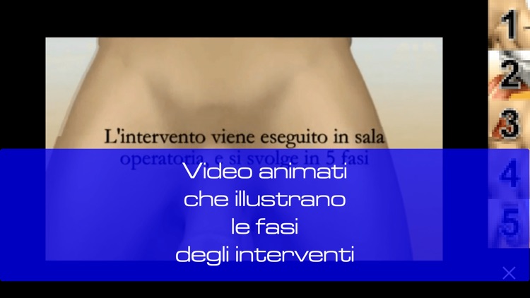 Falloplastica screenshot-4