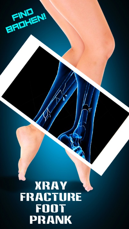 Xray Fracture Foot Prank