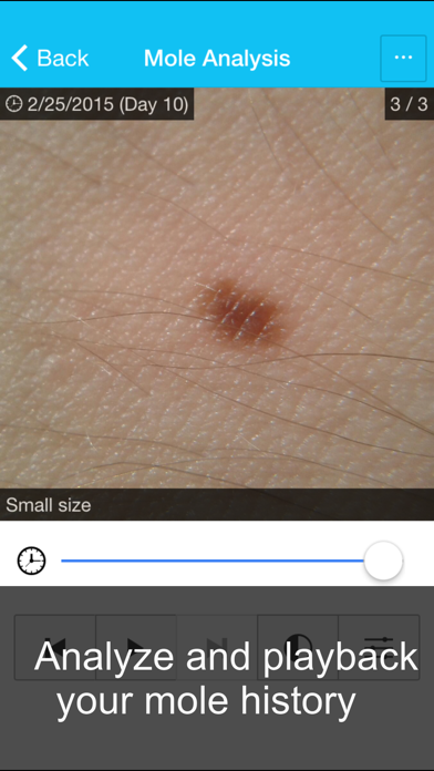 Skin Cancer App - MySkinPal - Map your skin moles Screenshot