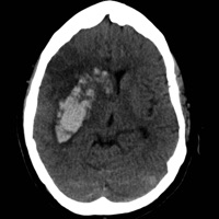 HeRS - Hemorrhage Risk Stratification Calculator app icon - Reference app for iPhone