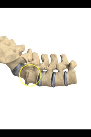 mLumbarDegenerativeDiscDisease screenshot 3