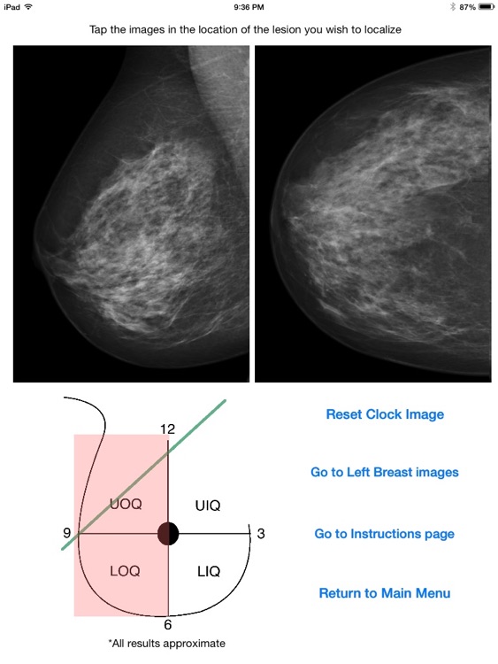 Mammography Localizer