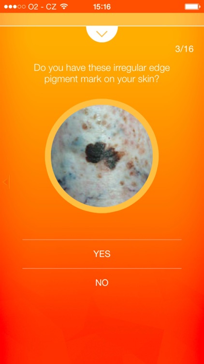 Melanoma Test - risk calculator of skin cancer