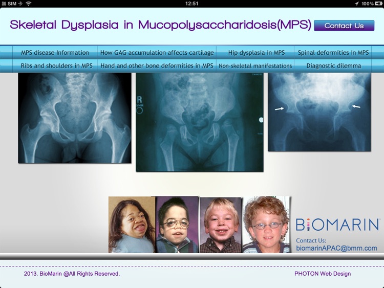 X rays in MPS
