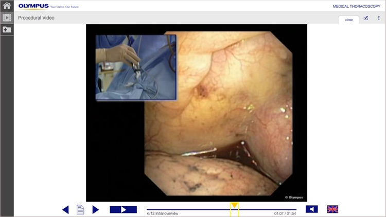 MedThora - Medical Thoracoscopy Under Local Anaesthesia