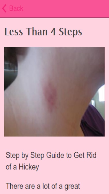 How To Get Rid Of Hickeys