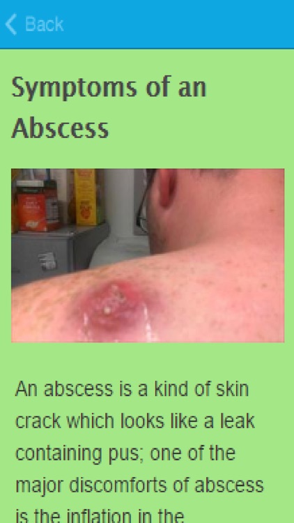 How To Treat An Abscess