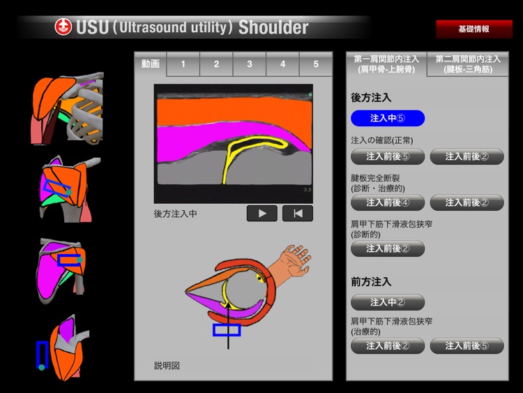 USU Shoulder