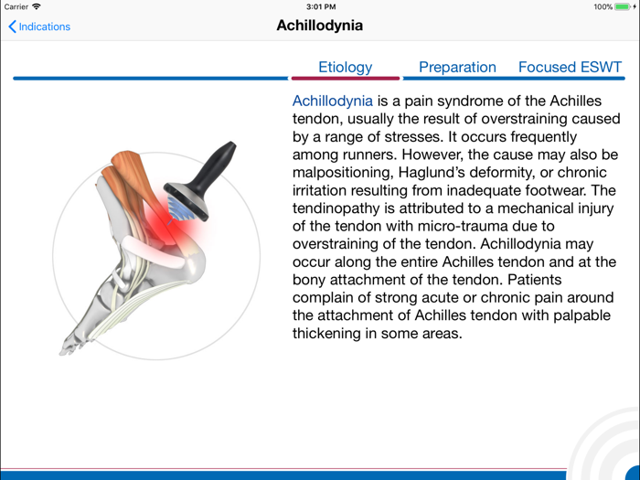 Shockwave Therapy