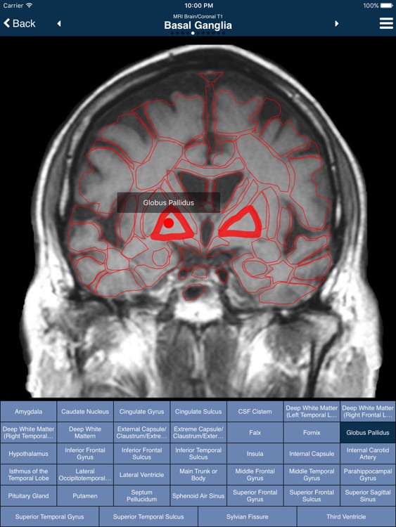 Nina Neuroimaging in Neurology screenshot-3