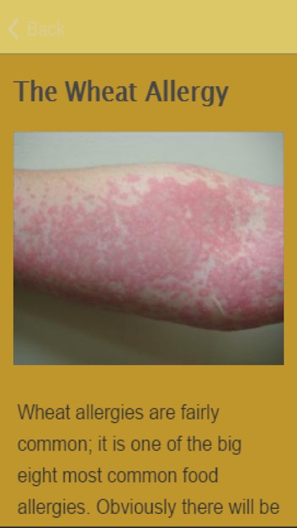 Symptoms Of Wheat Allergy