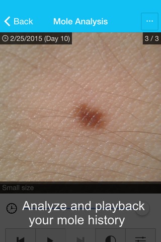 Skin Cancer App - MySkinPal -のおすすめ画像3