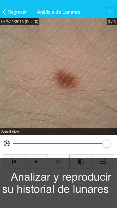 Cáncer De Piel - MySkinPal - Revisas tus lunares screenshot 3 of 5