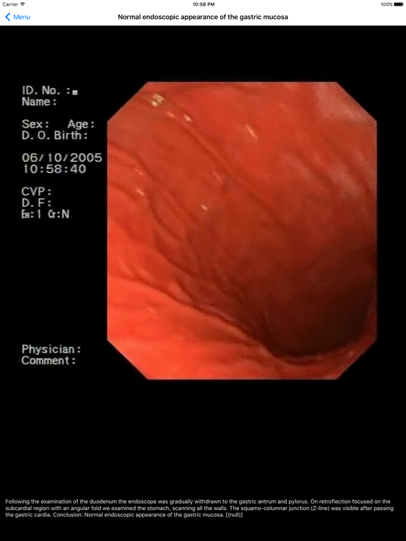 Screenshot #6 pour ENDO3® Atlas of Gastrointestinal Endoscopy - Lite