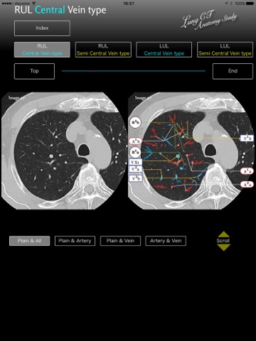 Lung CT Anatomy STUDY screenshot 2