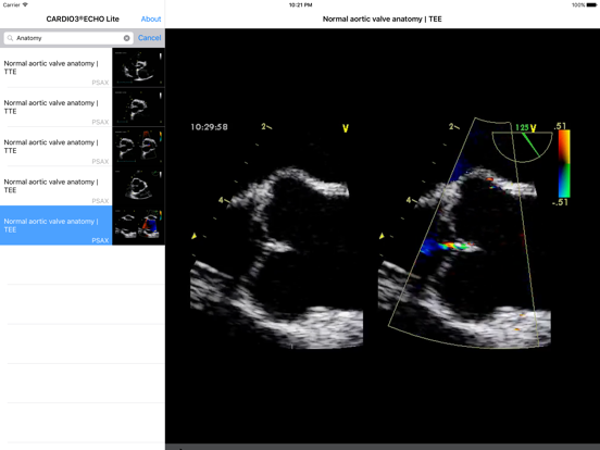 Screenshot #6 pour CARDIO3® Comprehensive Atlas of Echocardiography - Lite