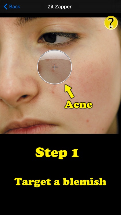 Zit Zapper Pro - Acne Remover