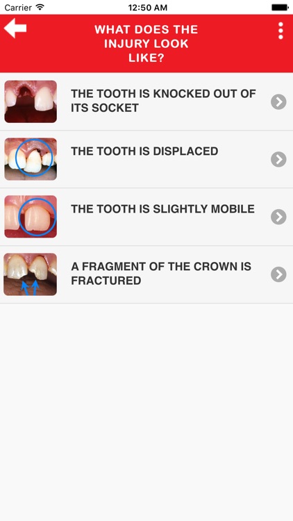 Dental Trauma