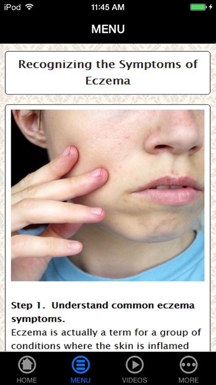 How To Treat Your Eczema - Best Way To Handle Your Eczema (Body, Face, Hand, Baby, etc.) For Beginners