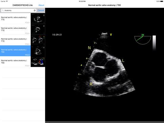 Screenshot #5 pour CARDIO3® Comprehensive Atlas of Echocardiography - Lite